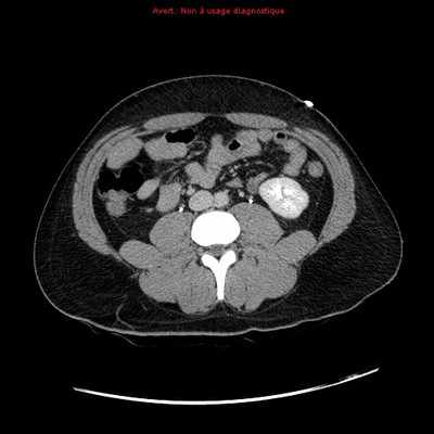 découvrez les causes d'une plaie par balle et les premiers gestes essentiels à adopter pour une prise en charge rapide et efficace.